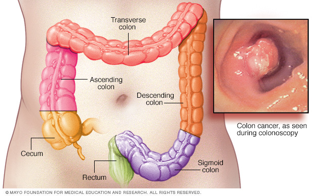 Colon Cancer Symptoms And Causes Mayo Clinic