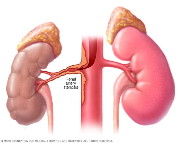 Renal Artery Stenosis Symptoms And Causes Mayo Clinic