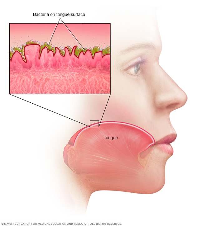 halitosis-mayo-clinic