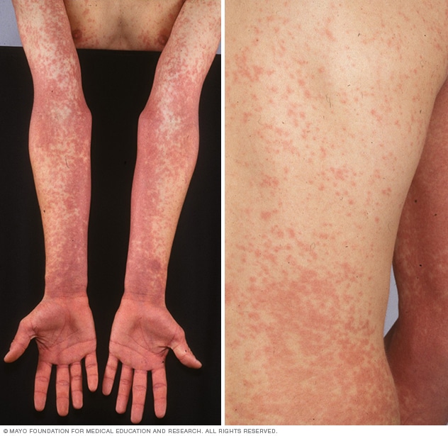 Photos showing scarlet fever