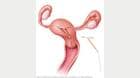 ParaGard IUD in place in the uterus