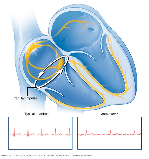 Atrial Flutter Mayo Clinic