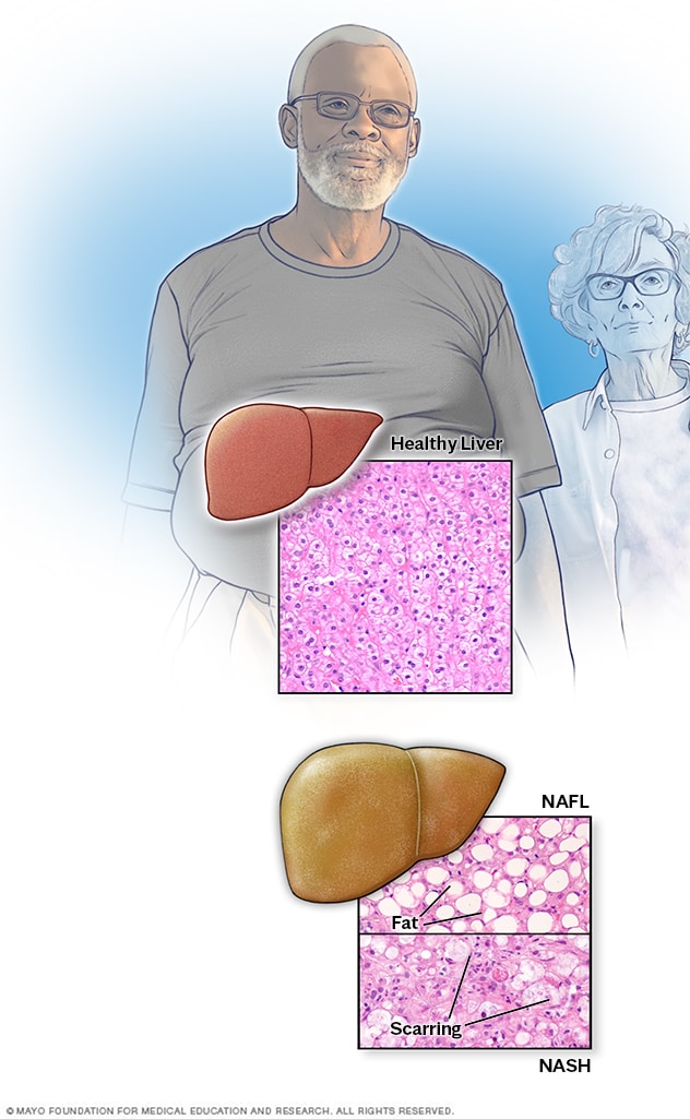 Microscopic view of healthy liver and nonalcoholic fatty liver