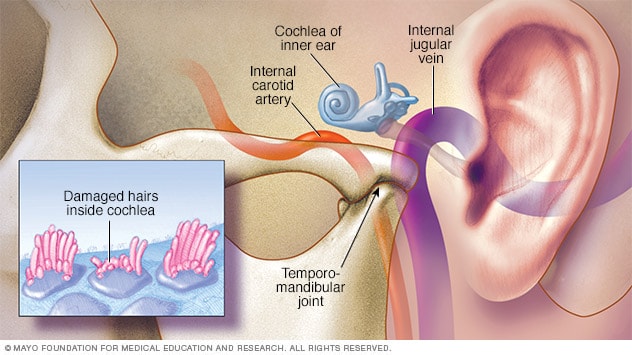 Interior del oído y cilios dañados