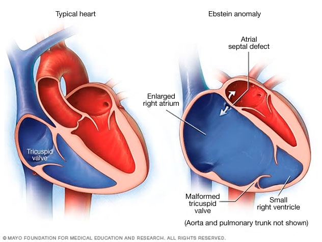 Anomal A De Ebstein Mayo Clinic