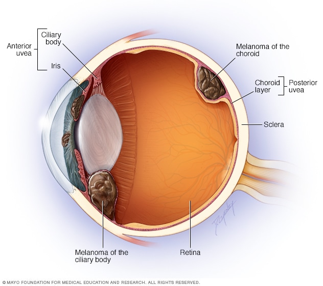 Ilustración de dónde se produce el melanoma de ojo
