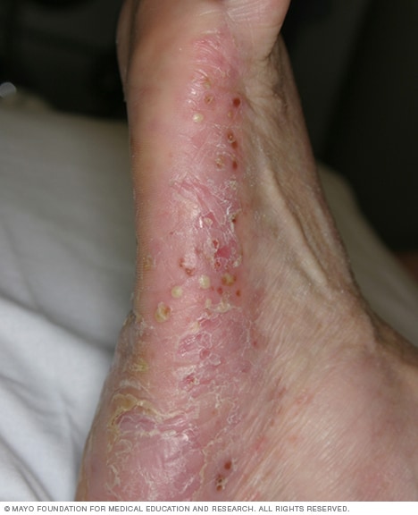 Psoriasis Symptoms And Causes Mayo Clinic 