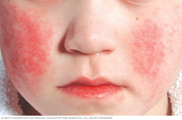 Photo showing face rash of parvovirus infection 
