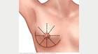 Wedge-shaped pattern for breast self-exam