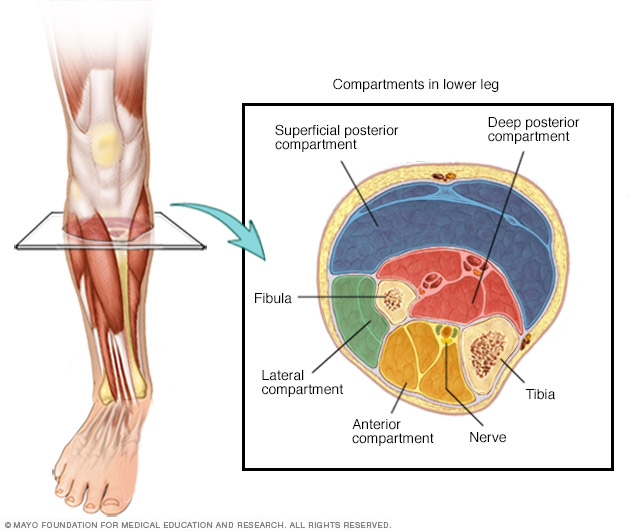 Chronic exertional compartment syndrome Mayo Clinic