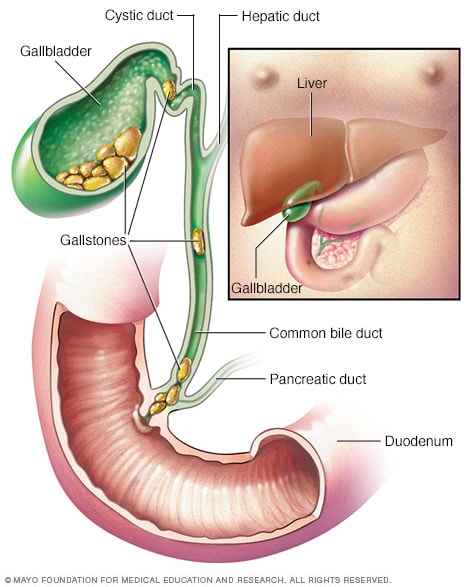 Gallbladder and gallstones 