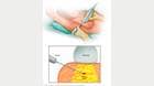 Core needle biopsy
