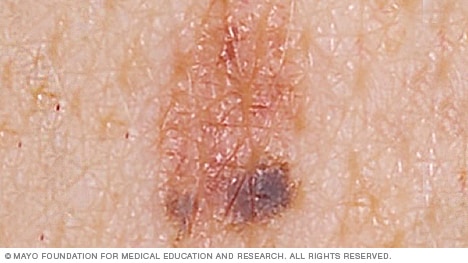 Slide Show: Melanoma Pictures To Help Identify Skin Cancer - Mayo Clinic