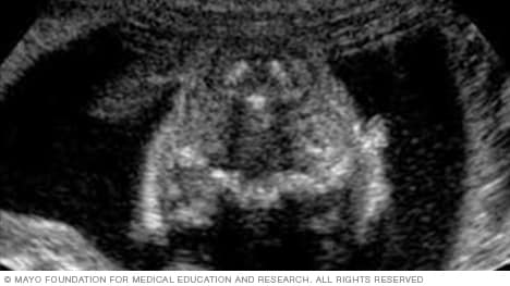 Slide show: Fetal ultrasound - Mayo Clinic