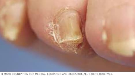A thickened toenail trimmed correctly