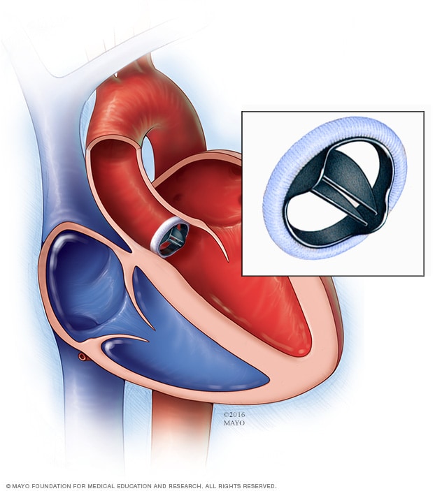 Heart valve surgery - About - Mayo Clinic