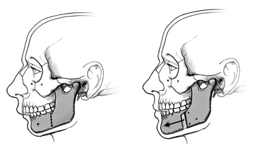 La mandíbula inferior se divide y la sección frontal se mueve hacia adelante o hacia atrás, y se fija con placas y tornillos. 