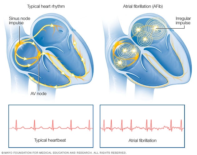 Atrial Fibrillation Symptoms And Causes Mayo Clinic