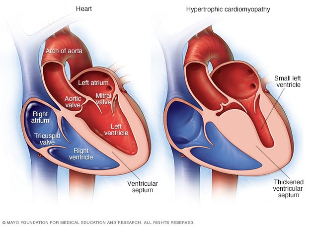 Un corazón normal y un corazón con miocardiopatía hipertrófica
