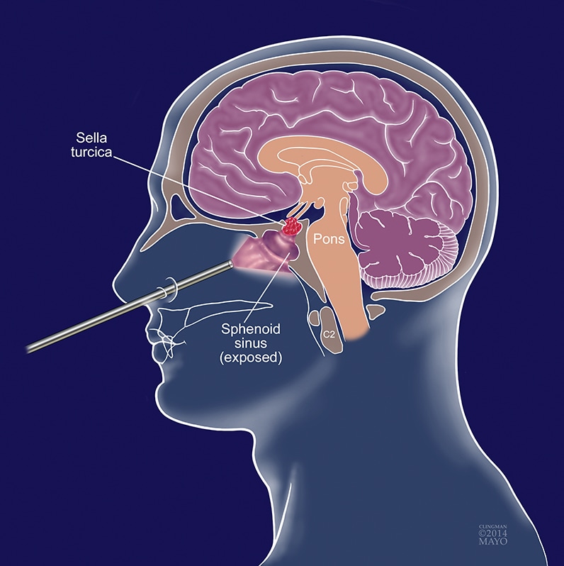 Illustration of endoscopic endonasal approach
