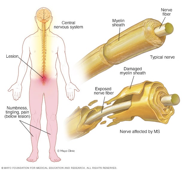 MS-related nervous system damage
