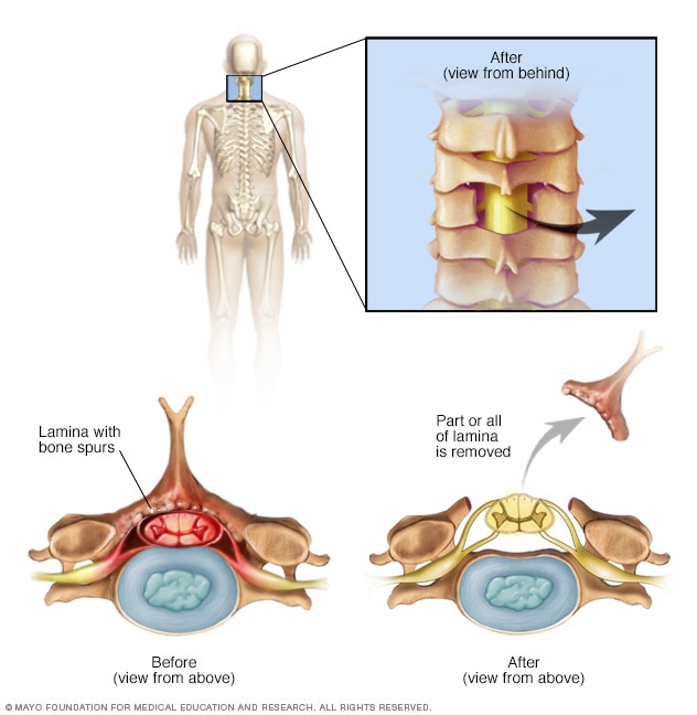 spinal-stenosis-diagnosis-and-treatment-mayo-clinic