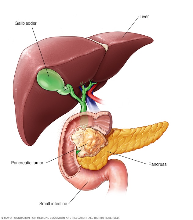 Diet Pancreatic Cancer Patients
