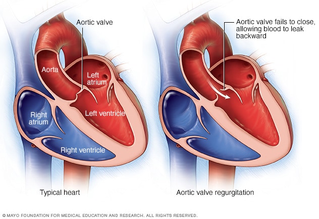 aortic-valve-regurgitation-mayo-clinic