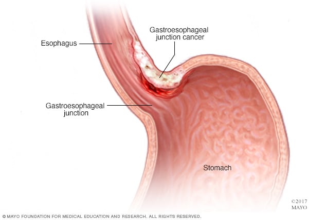 سرطان الموصل المعدي المريئي