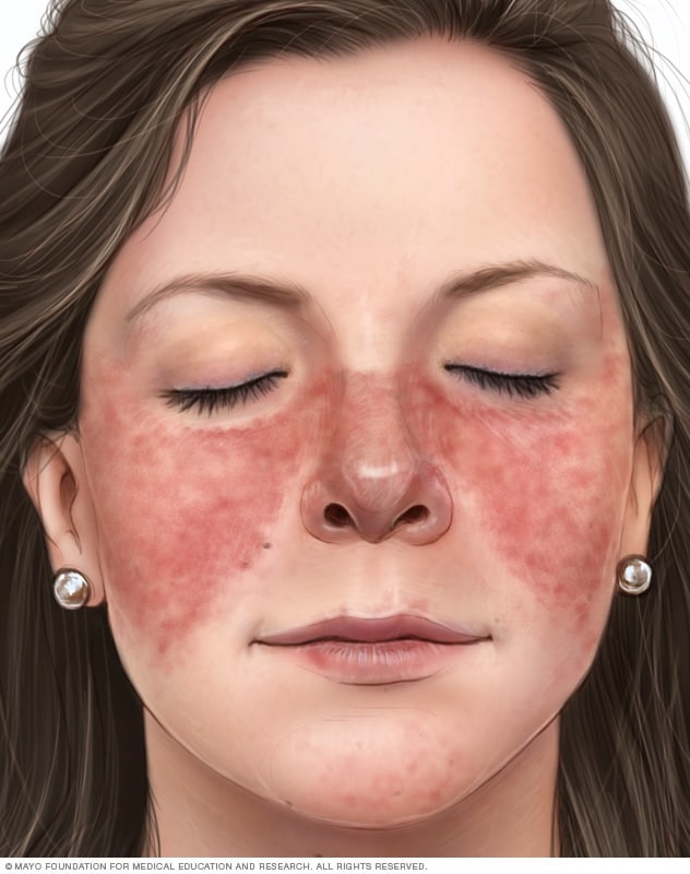 lupus-facial-rash-mayo-clinic