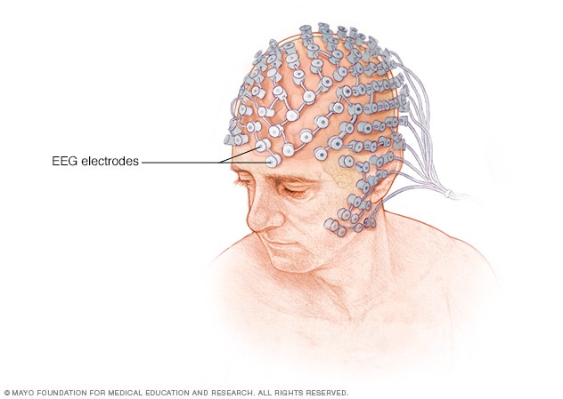 高密度 EEG 检测中电极的放置
