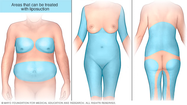 Áreas en el abdomen, el pecho, la espalda, las piernas y los brazos que se pueden tratar con liposucción