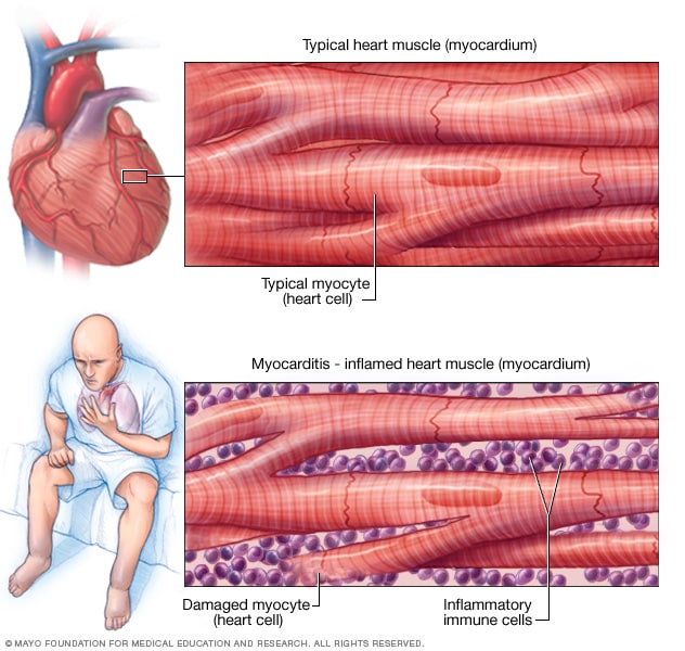 Ilustración del músculo cardíaco inflamado.