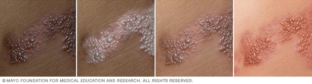 Shingles rash on different skin colors.