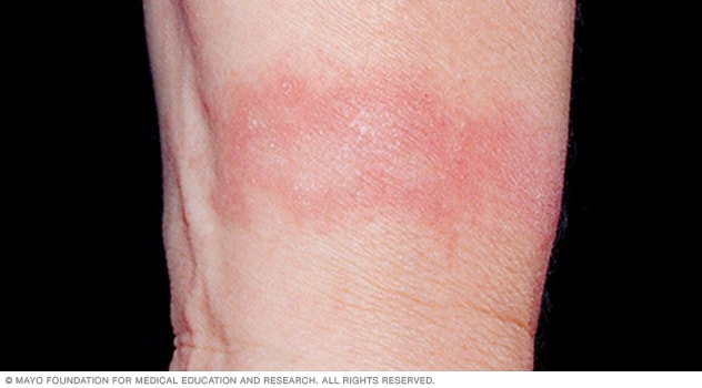 Dermatitis irritante por contacto probablemente causada por jabón residual bien atrapado en la piel