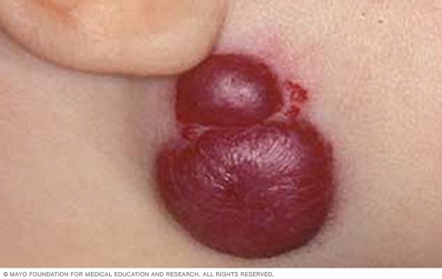 Image of a hemangioma birthmark below an ear