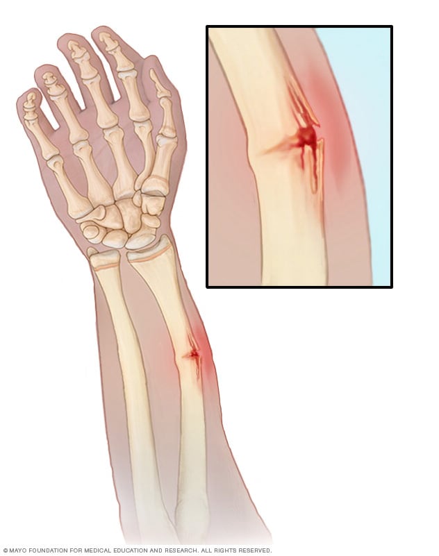 Illustration showing a greenstick fracture 
