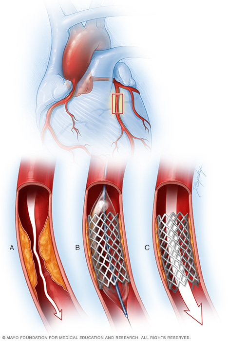 Illustration showing a coronary artery stent 