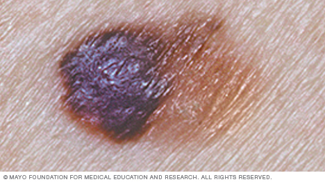 melanoma cancer skin asymmetry identify asymmetrical show mayo clinic conditions diseases color slide help previous next mayoclinic