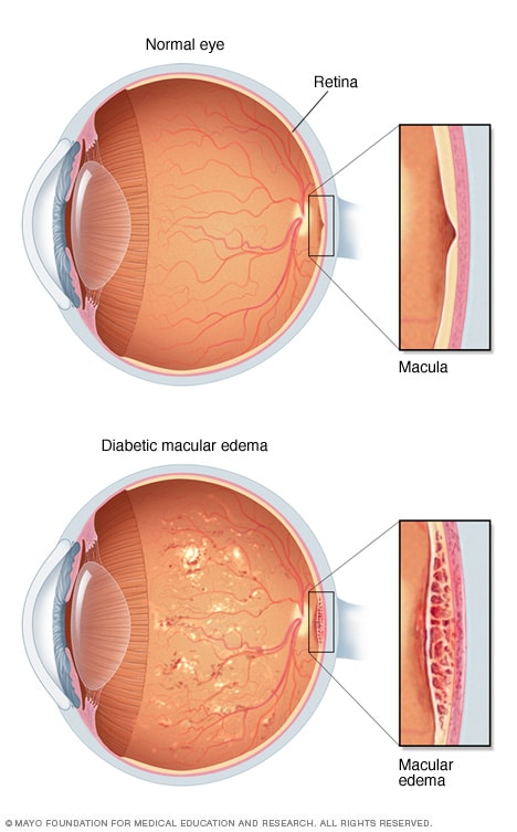 diabetic-macular-edema-mayo-clinic