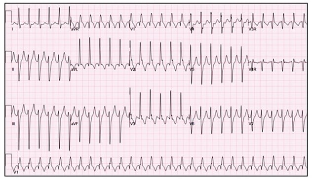 Pediatric ventricular arrhythmia in a normal heart For