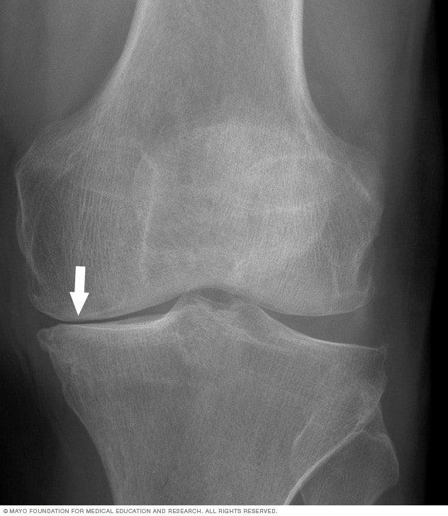 膝关节炎的 X 线图片