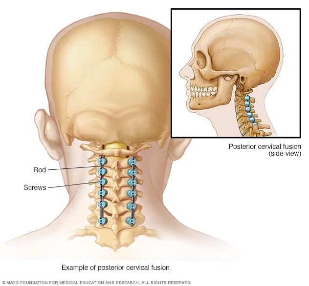 spinal-fusion-mayo-clinic