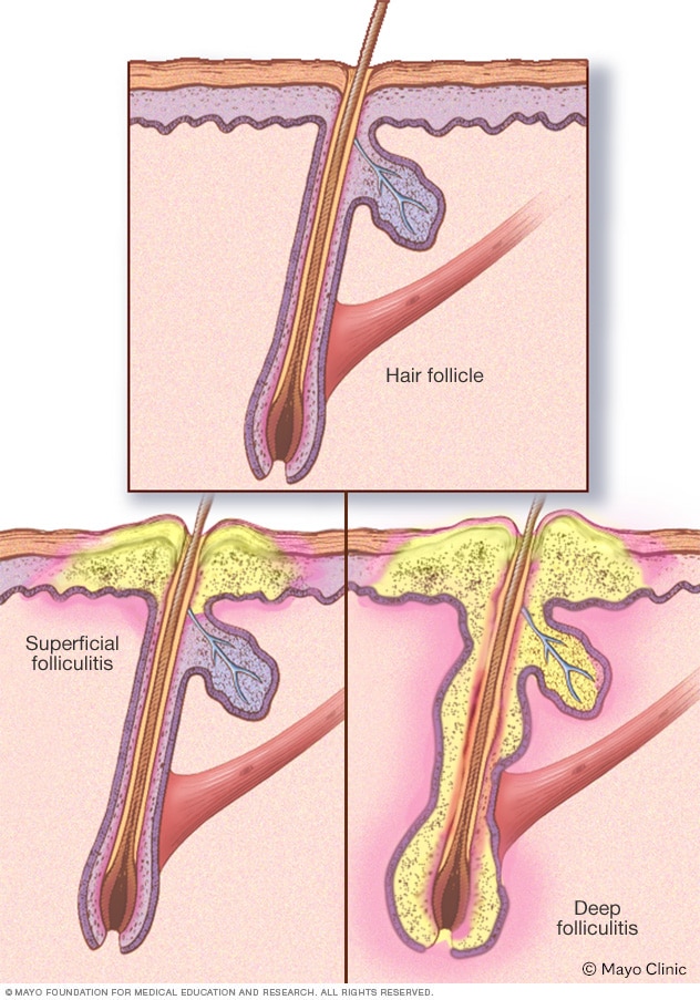 Folliculitis - Symptoms and causes - Mayo Clinic