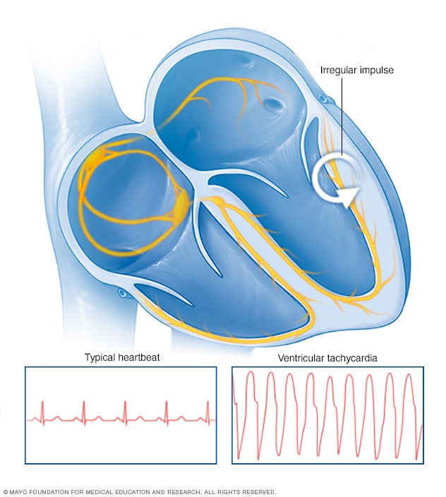 Ventricular Tachycardia Symptoms And Causes Mayo Clinic