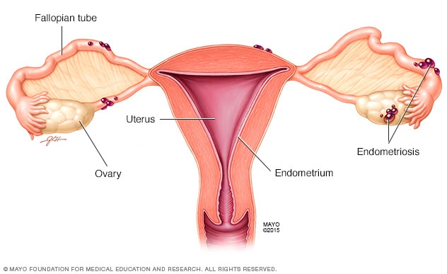 Endometriosis Symptoms And Causes Mayo Clinic 4131