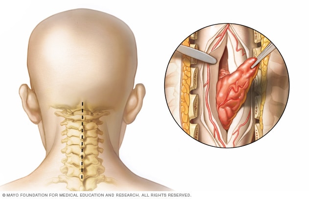 spinal-cord-tumor-diagnosis-and-treatment-mayo-clinic