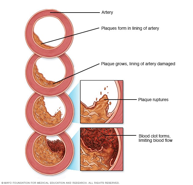 Arteriosclerosis / atherosclerosis Symptoms and causes Mayo Clinic