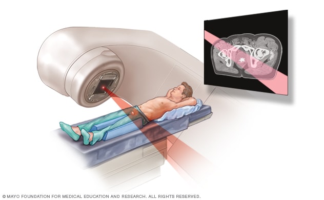 External beam radiation for prostate cancer Mayo Clinic