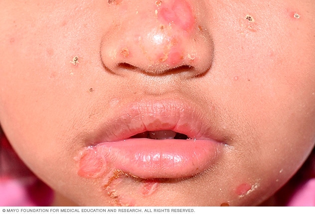 Impetigo - Symptoms and causes - Mayo Clinic